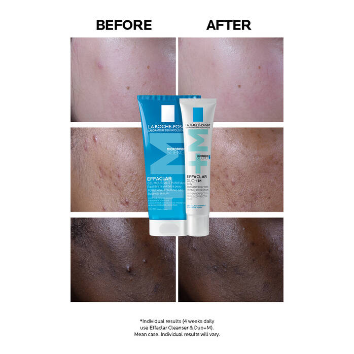 Before and after comparison of skin treatment with La Roche-Posay products displayed.
