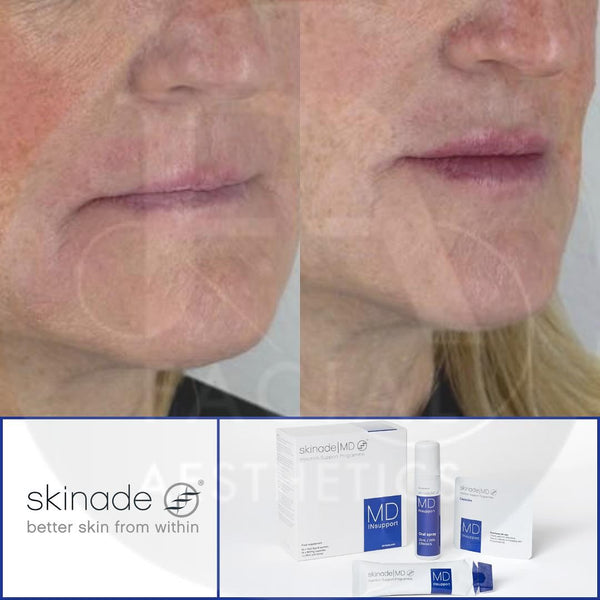 Skinade INsupport