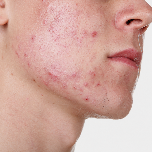 Oily Skin