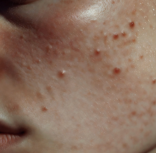 ACNE/BLEMISH