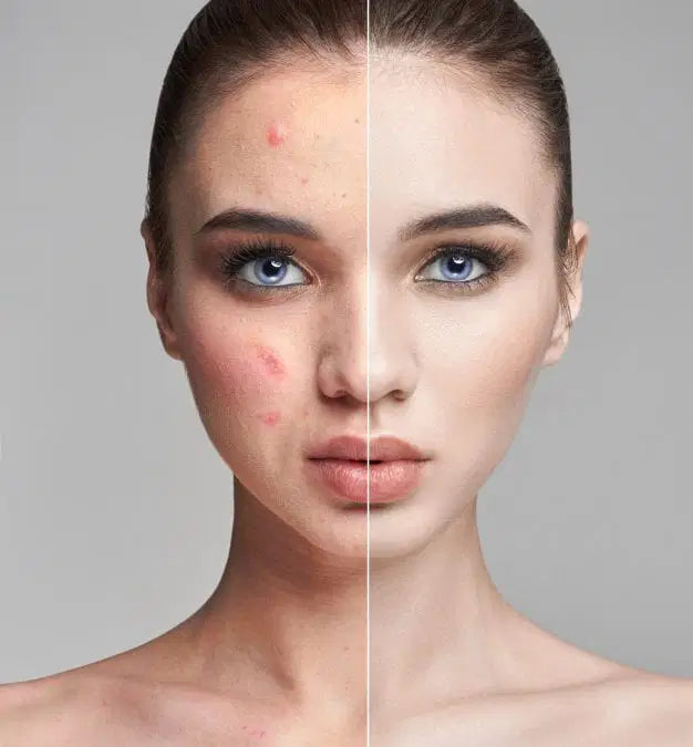 Teenage Skin