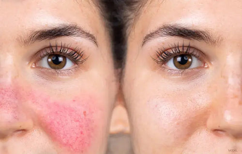 ROSACEA
