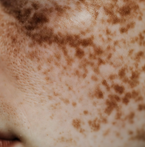 PIGMENTED