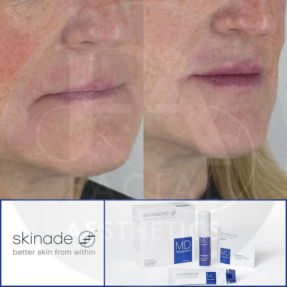 Skinade INsupport Skinade