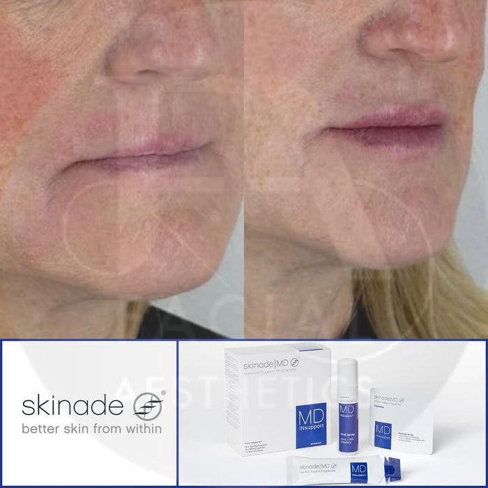 Skinade INsupport Skinade