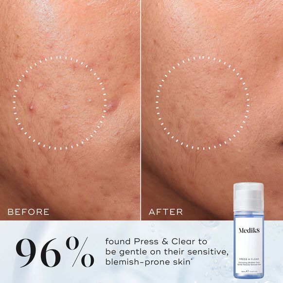 Before and after comparison of skin with Medik8 Press & Clear toner, showing effectiveness on sensitive blemish-prone skin.