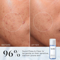 Before and after comparison of skin with Medik8 Press & Clear toner, showing effectiveness on sensitive blemish-prone skin.